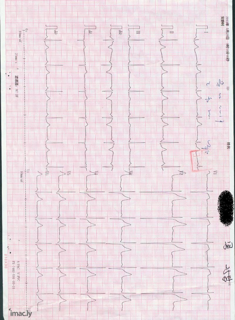 亲们好，我最近体检了，心电图结论是1.窦性心律2....-1.jpg