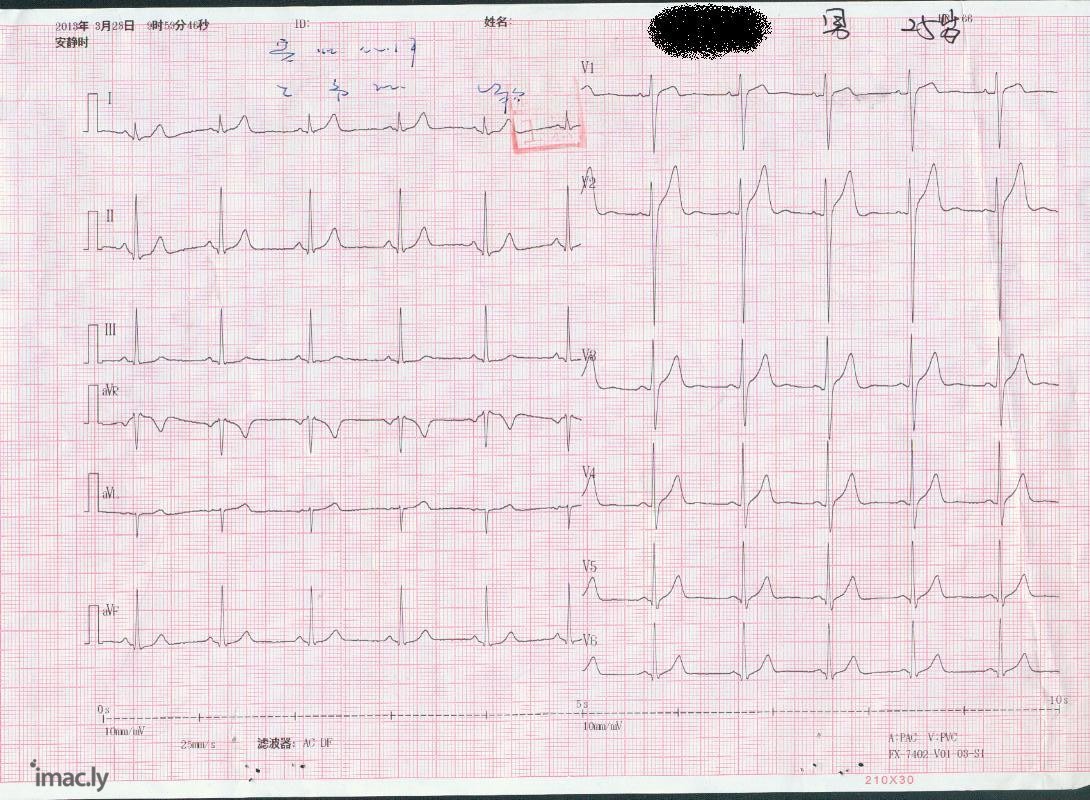 亲们好，我最近体检了，心电图结论是1.窦性心律2....-2.jpg