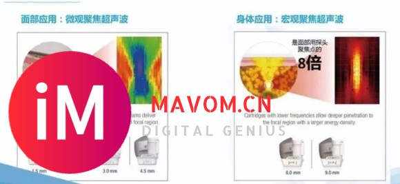 惊吓到了—7d聚拉提后面部凹陷就是~7d聚拉提危害真的没有几人知-7.jpg