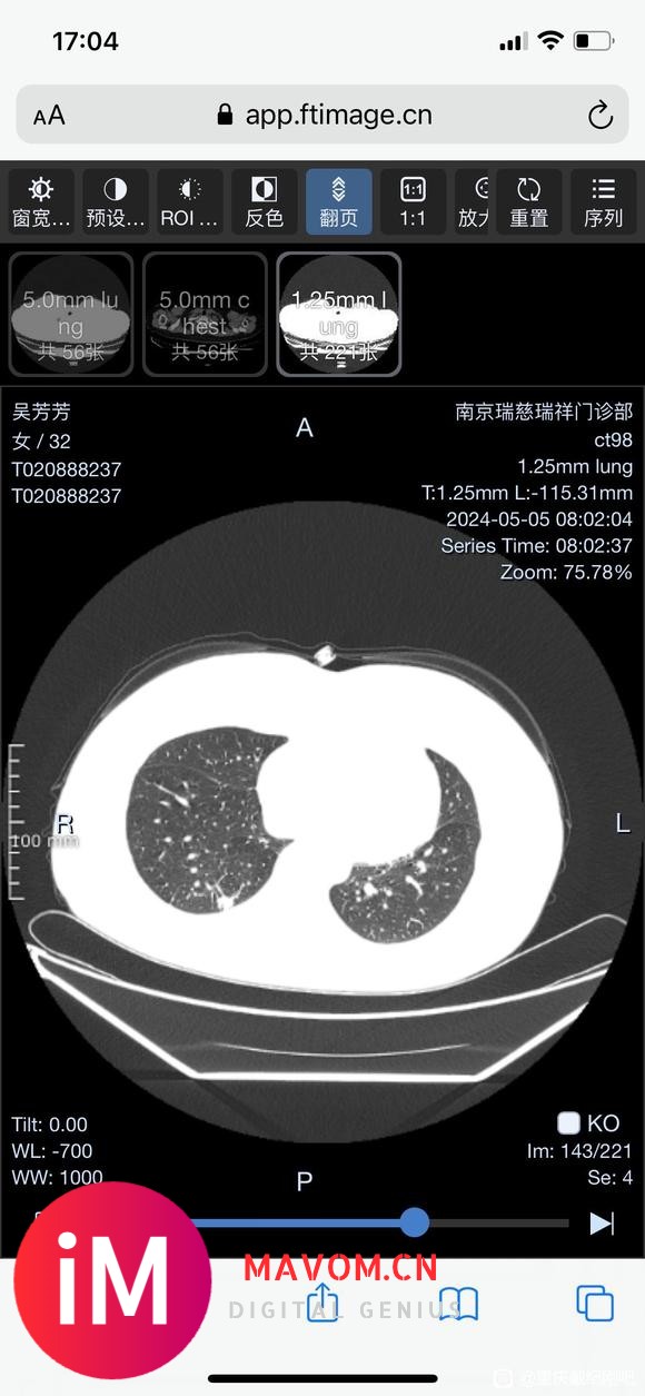 宝妈求助：做完磨玻璃又发现实性结节，请戴主任帮忙看看-2.jpg