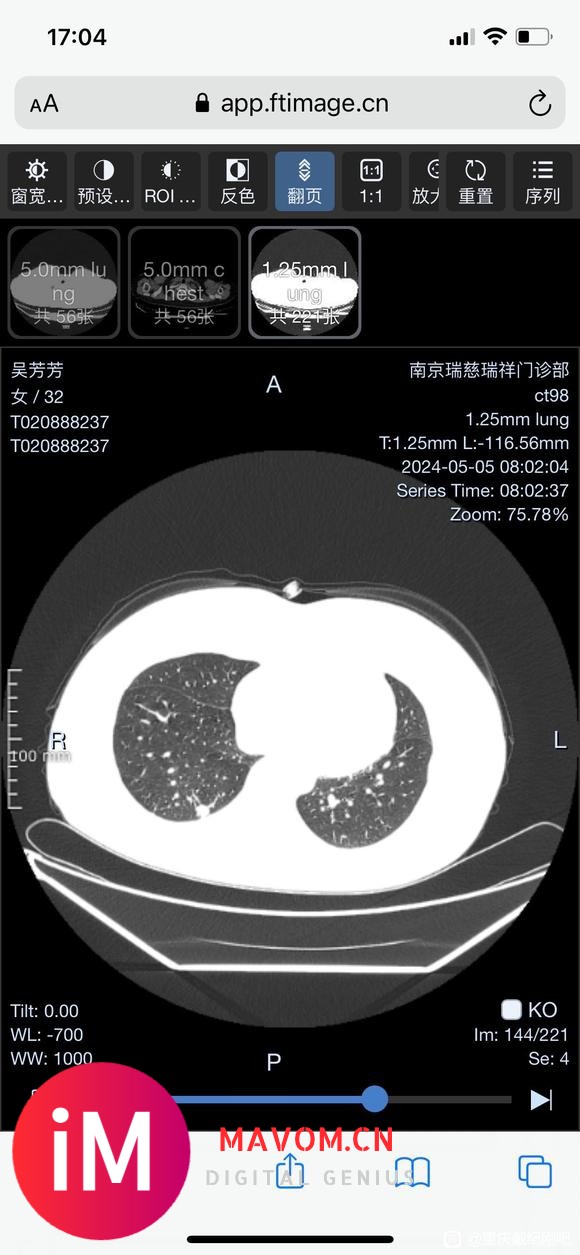 宝妈求助：做完磨玻璃又发现实性结节，请戴主任帮忙看看-3.jpg