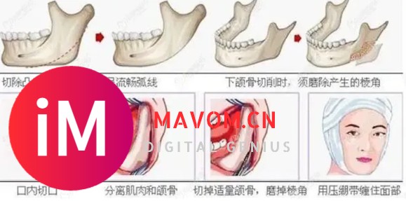 专业回答：颧骨内推老了会怎么样？颧骨内推有什么后遗症？-7.jpg