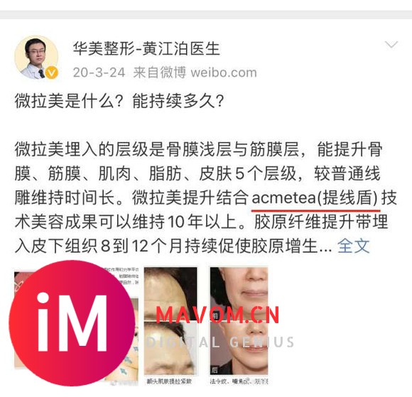 吓死了~微拉美面部提升后遗症、微拉美的危害和副作用专业解说-9.jpg